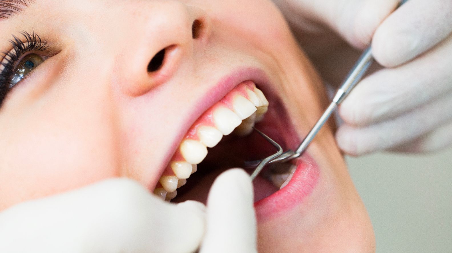 Fillings and Root Canals