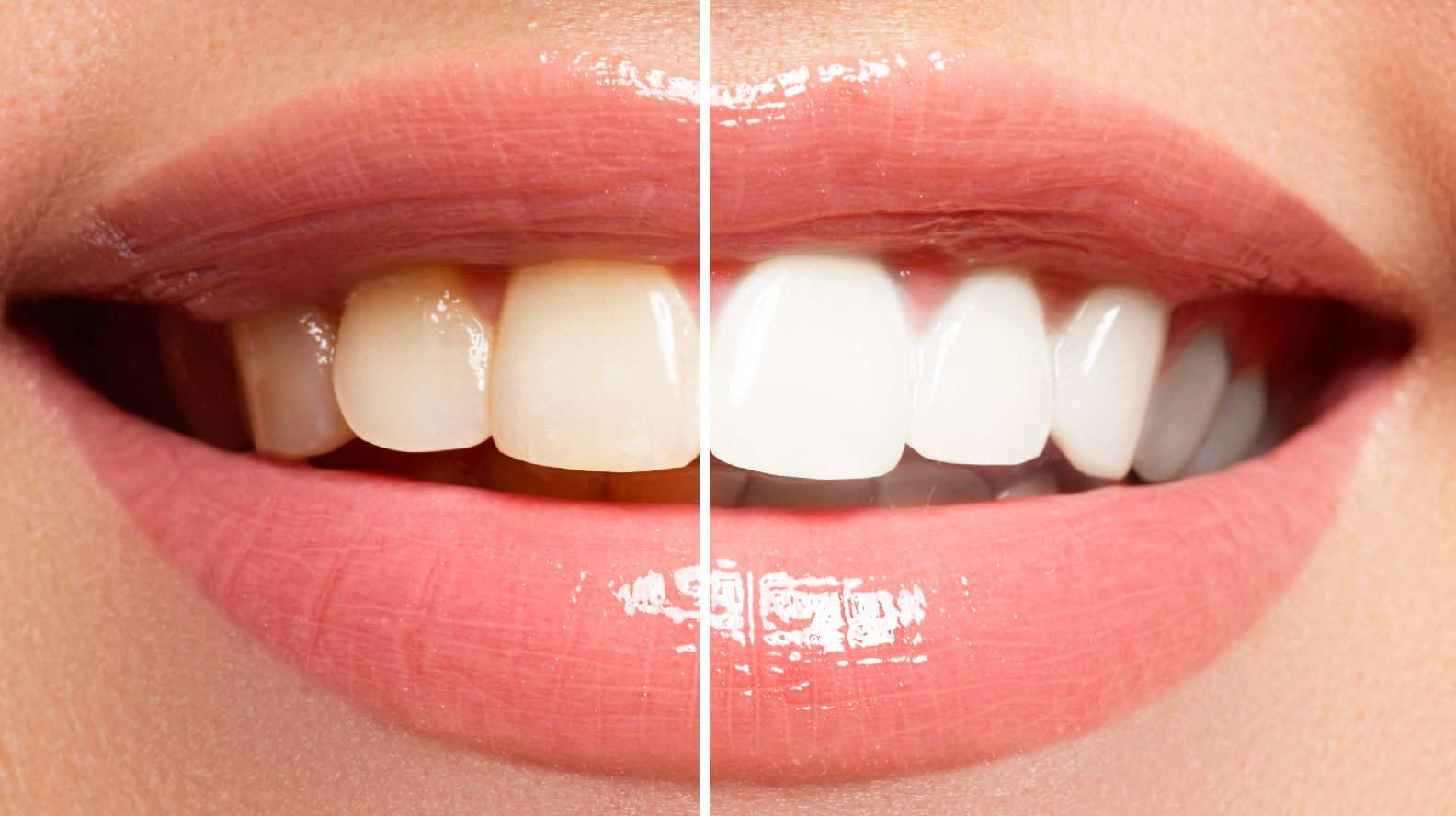 Teeth Whitening (Teeth Bleaching)