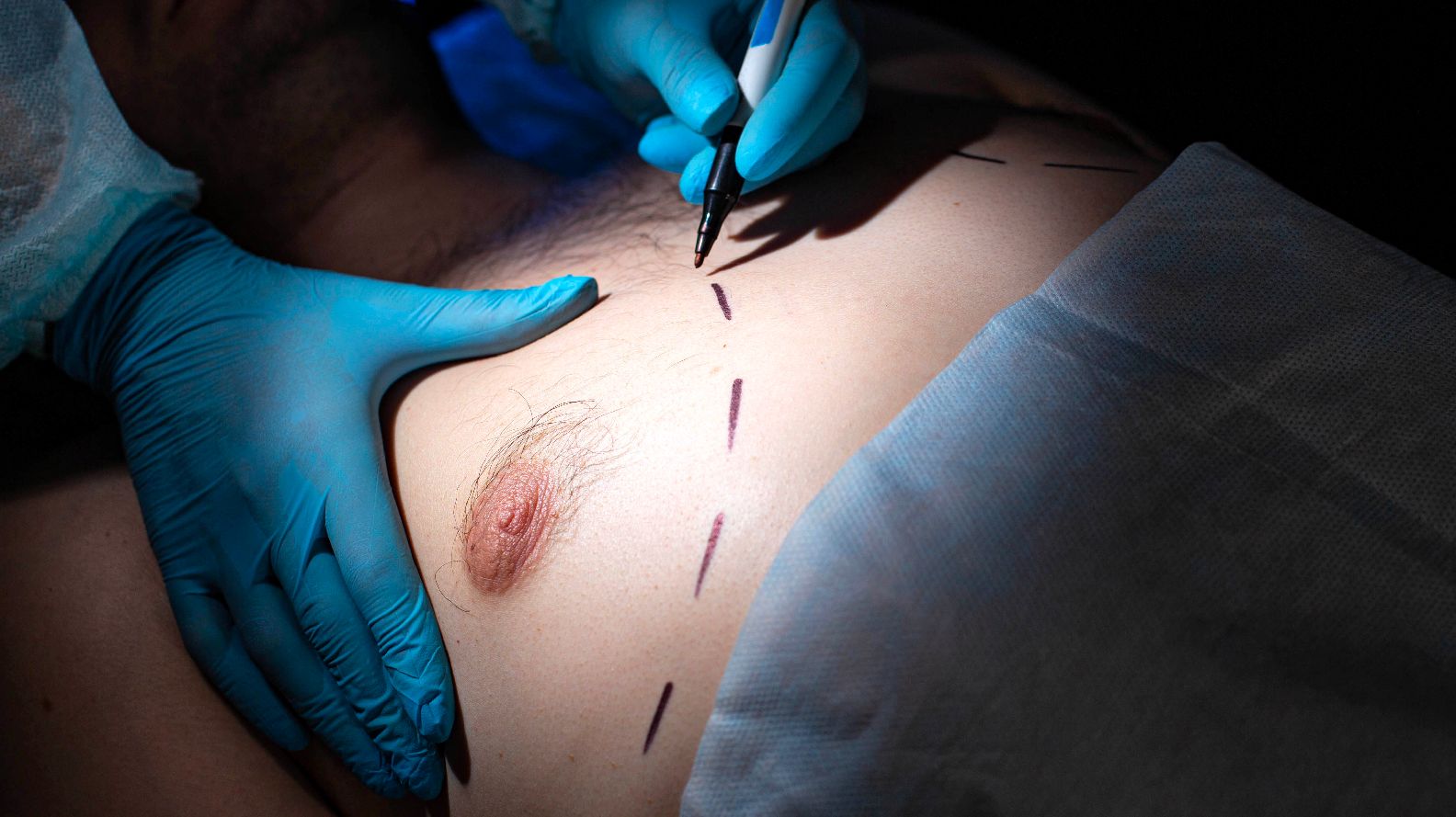 Cirugía de la ginecomastia